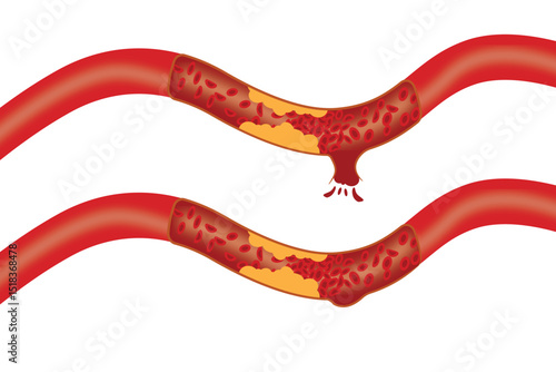 Medical diagram showing atherosclerosis progression and artery rupture with blood leakage.