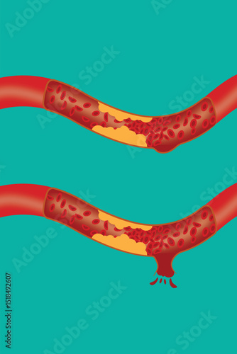 Illustration of artery plaque buildup and rupture causing blood leakage and vascular damage. eps 10