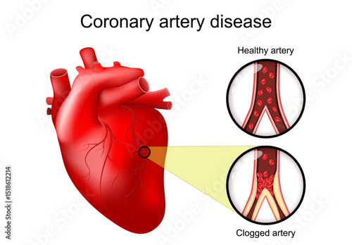 Coronary artery disease. Realistic human heart, cross section of artery