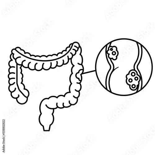 Colorectal Cancer disease