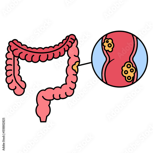 Colorectal Cancer disease illustration