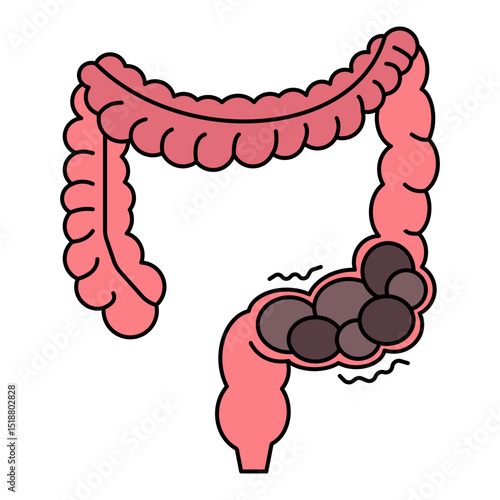 colon constipation illustration