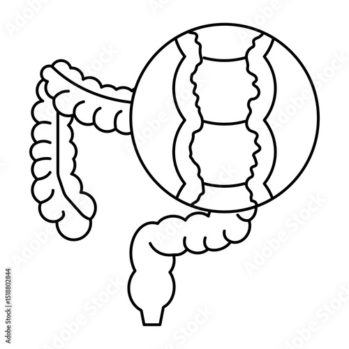 Colon Crohn's Disease