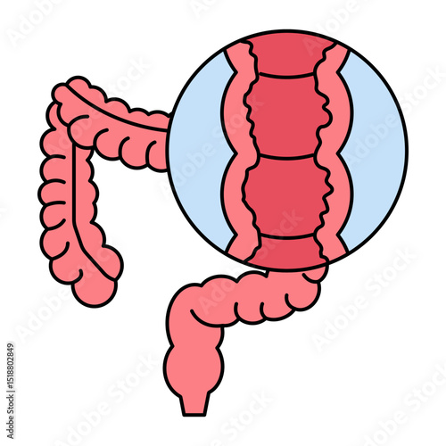 Colon Crohn's Disease illustration