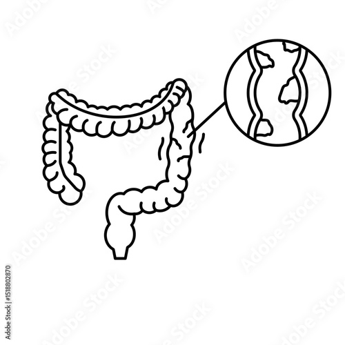 ulcerative colitis