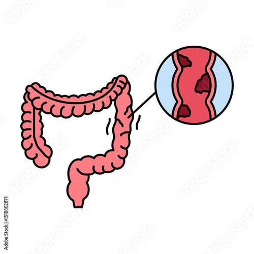 ulcerative colitis illustration