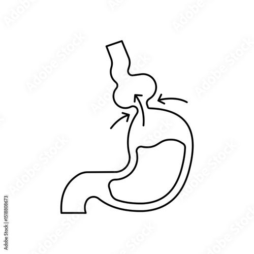 Hiatal Hernia Disease