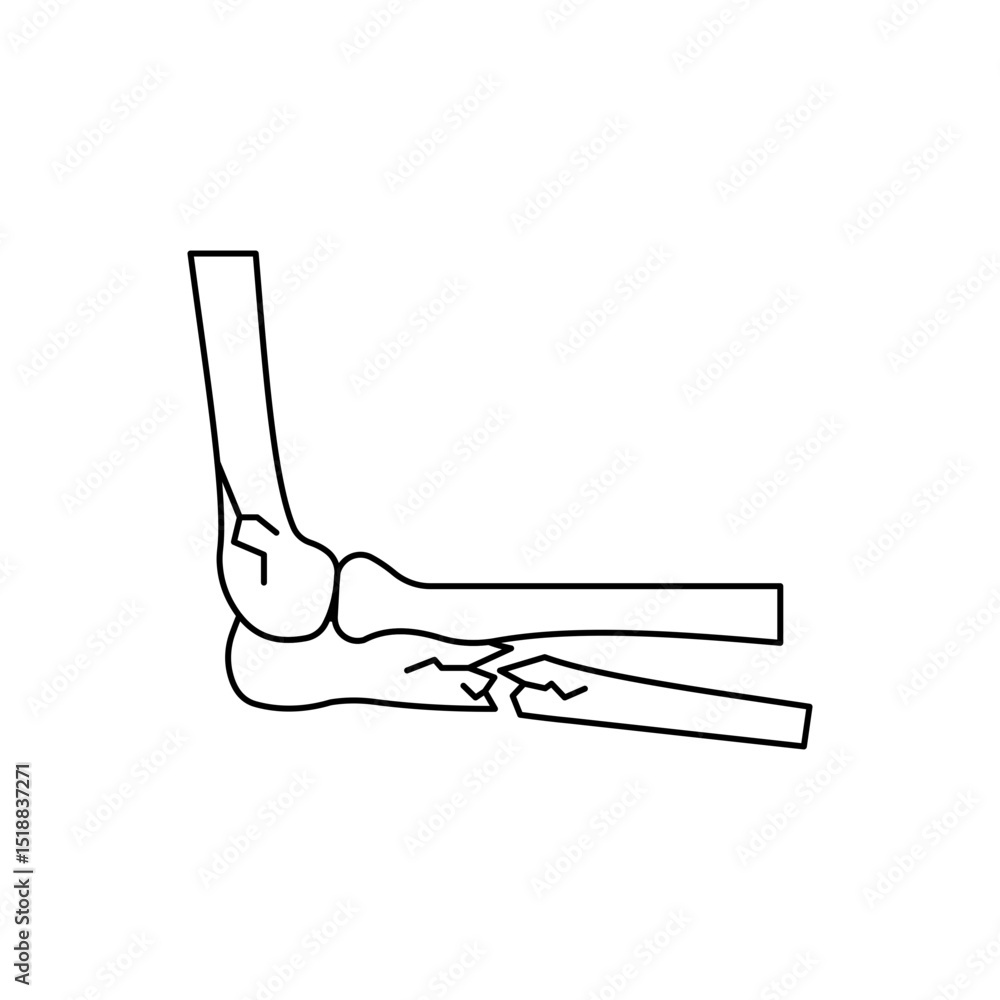 Elbow fracture Elbow fracture