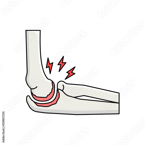 Elbow arthritis disease