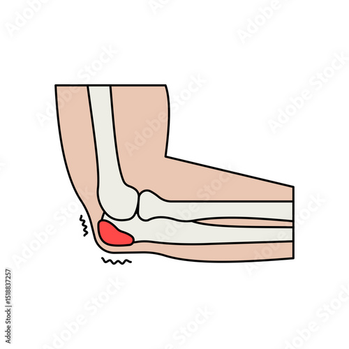 Elbow Bursitis disease