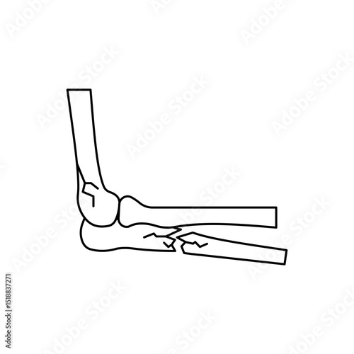 Elbow fracture