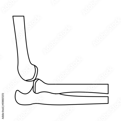 elbow dislocation