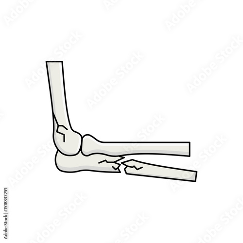 Elbow fracture