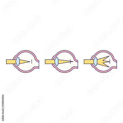 Refractive error