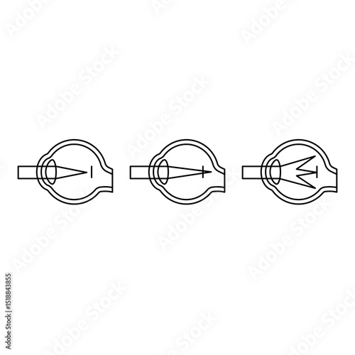 Refractive error