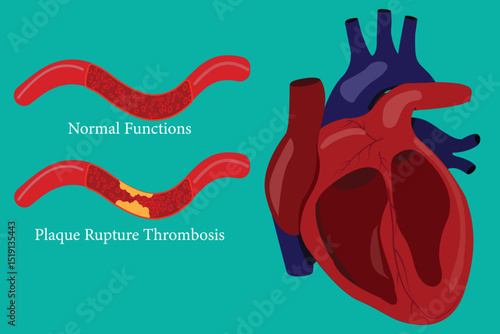 Healthy and diseased artery comparison with heart anatomy, medical illustration.