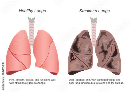 Healthy Lung and Smokers Lung isolated on white.