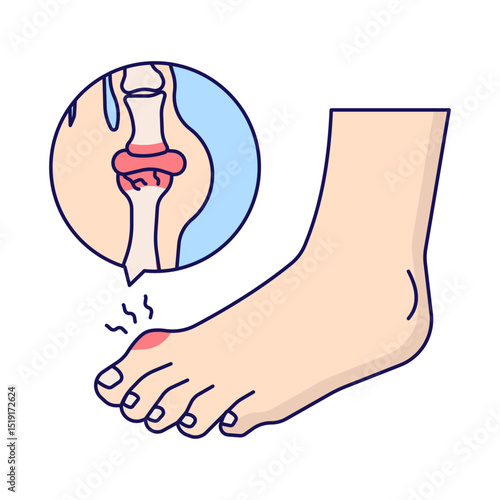 Gout disease