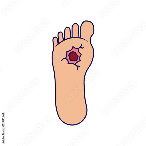 Diabetic foot ulcer