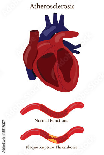 Atherosclerosis heart illustration with comparison of normal artery and plaque rupture thrombosis.