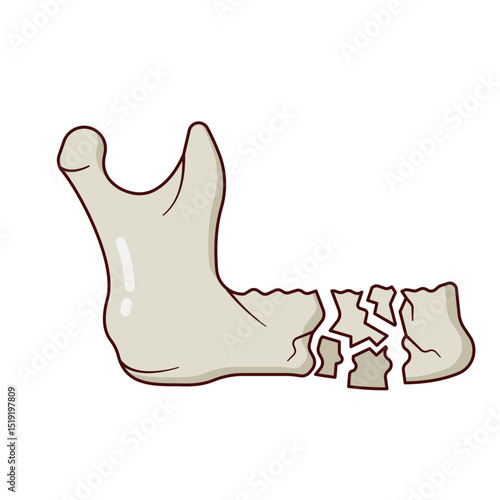 Mandibule Fracture