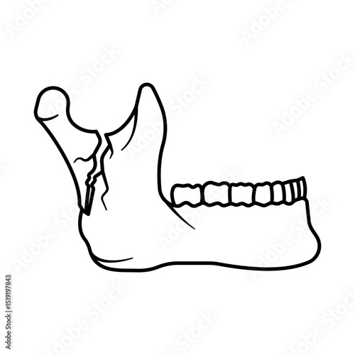 Mandibule Fracture