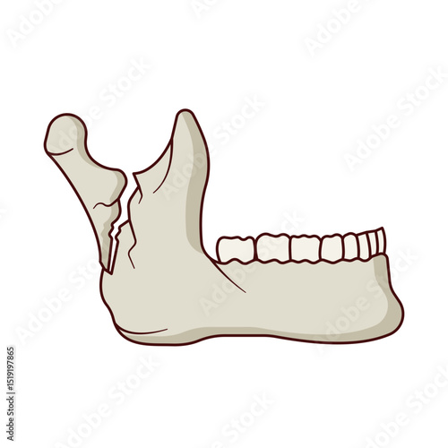 Mandibule Fracture