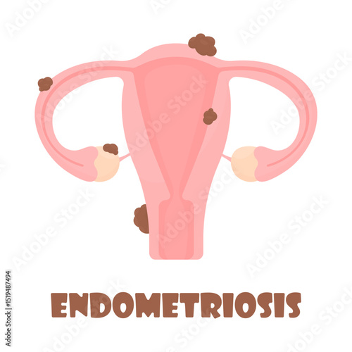 Female uterus affected by endometriosis. Unhealthy female reproductive system. Women's health concept
