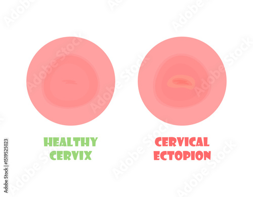 Healthy cervix and with ectopia. The most common disease of the female reproductive system. Women's health concept