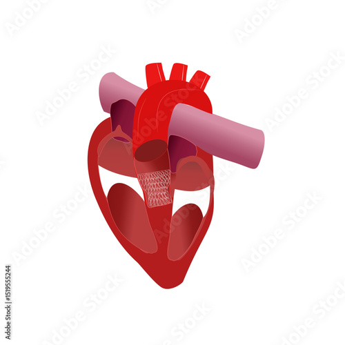 Cardiac model of Transcatheter aortic valve implantation
( TAVI )
