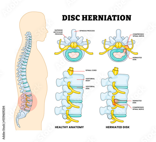 Disc Herniation with Spinal Bone Spine Disease Educational Medical Poster Design Healthcare Scheme, Labeled Compressed Spinal Nerves, Articular Process, Spinous Process, Vertebral Body Disk.