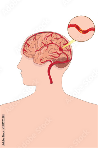 Medical diagram showing cerebral artery obstruction causing ischemic stroke in the brain.
