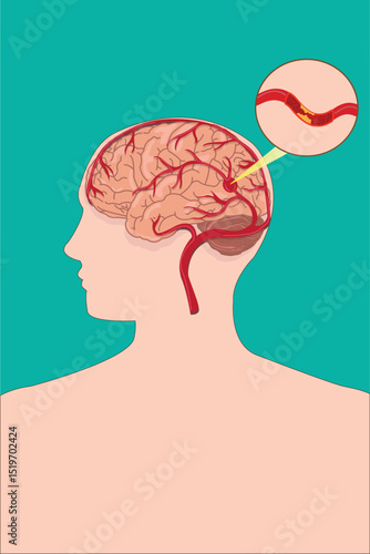 Human brain artery blockage, stroke illustration with highlighted blood clot in vessel.