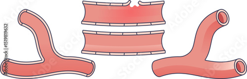 Illustration of blood vessels showing healthy and damaged sections.