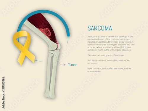 Osteosarcoma showing bone cancer and gold ribbon