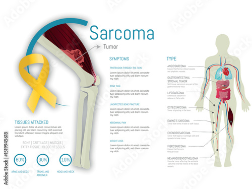 Sarcoma cancer showing symptoms, types, tissues attacked, and affected body areas