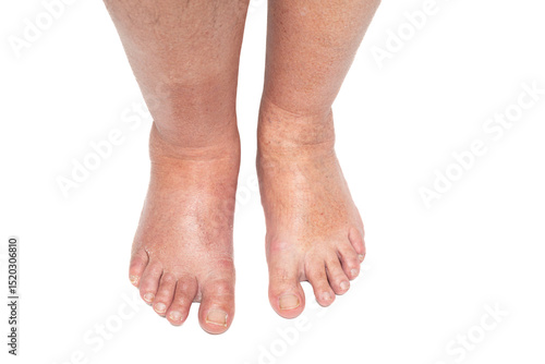 Swollen leg caused by a broken toe. Unrecognizable man with swollen feet, tired and painful legs.Edema lower limbs