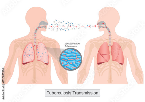 Tuberculosis is spread through the air from one person to another.