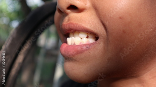Kid patient open mouth showing cavities teeth decay. Child smile and show her crowding tooth. Close up of unhealthy baby teeths.teeth of a 10 year old child