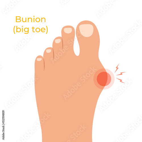 Human foot with deformities of big toe joint. Bare foot with Hallux valgus deformation. Vector illustration