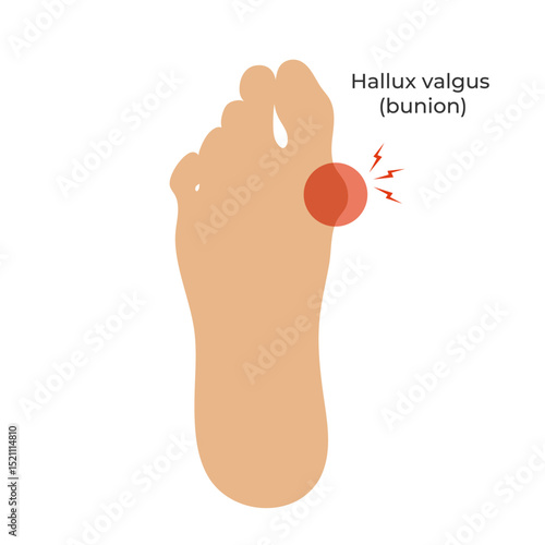 Silhouette of a human foot with a Hallux valgus deformation. Bunion of a big toe. Vector illustration