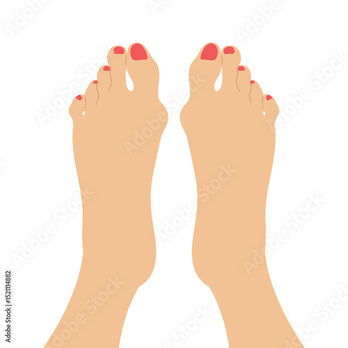 Women feet with a Hallux valgus deformation. Bunion of a big toe. Vector illustration
