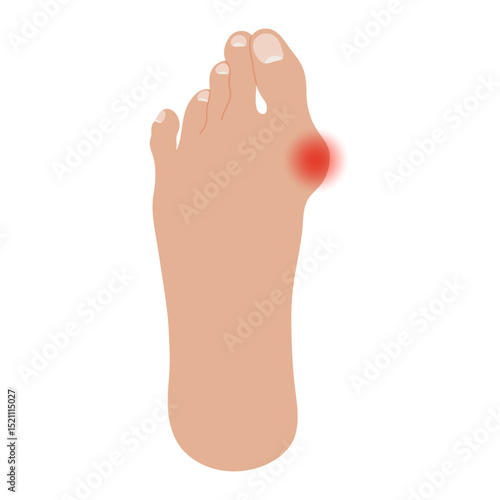 Bare foot with Hallux valgus deformation. Human foot sole with deformities of big toe joint. Vector illustration