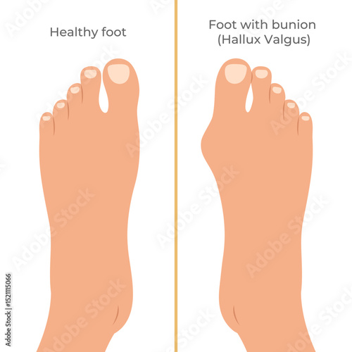 Healthy foot and foot with a Hallux valgus deformation. Bunion of a big toe. Vector illustration