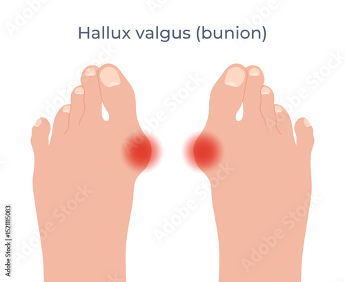 Feet with a bunion of a big toe. Hallux valgus deformation. Vector illustration