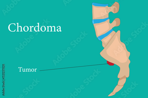 Medical illustration of chordoma tumor on tailbone (sacrum) in human spine anatomy.