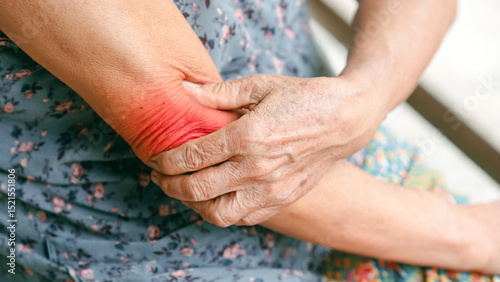 Close up of elderly woman holding painful red swollen elbow indicating joint inflammation arthritis or allergic skin reaction