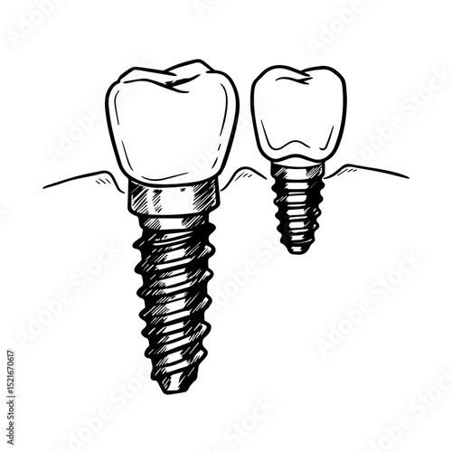 Dental implant crowns illustration showing two different sizes of implants. Detailed drawing of dental implants with crowns, showcasing implant screw and tooth structure.