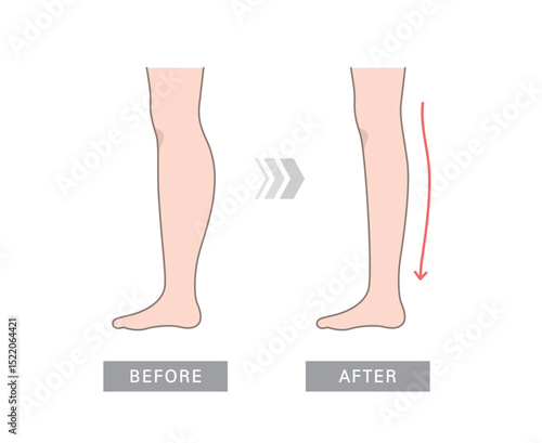 Diet before and after (leg thin). Fat obese leg and slim size leg comparison.