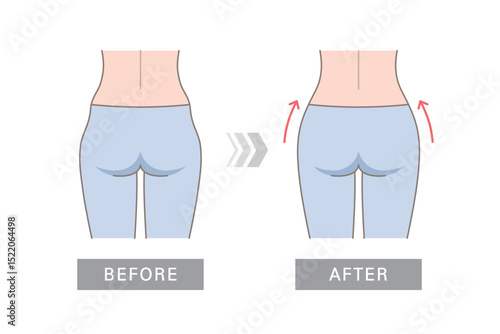 Hip dips before and after comparison. Perfect figure of female pelvis after filler.